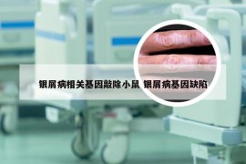 银屑病相关基因敲除小鼠 银屑病基因缺陷