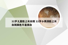 11岁儿童脸上长白斑 11岁小男孩脸上长白斑颜色不是很白