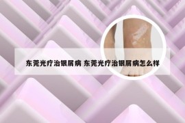 东莞光疗治银屑病 东莞光疗治银屑病怎么样