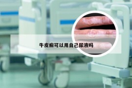 牛皮癣可以用自己尿液吗