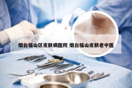 烟台福山区皮肤病医院 烟台福山皮肤老中医