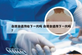 白斑会遗传给下一代吗 白斑会遗传下一代吗?