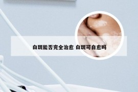 白斑能否完全治愈 白斑可自愈吗