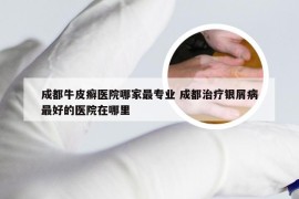 成都牛皮癣医院哪家最专业 成都治疗银屑病最好的医院在哪里