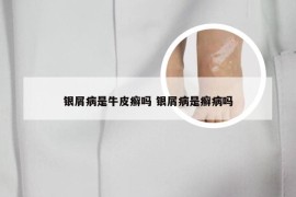 银屑病是牛皮癣吗 银屑病是癣病吗