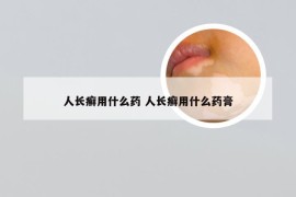 人长癣用什么药 人长癣用什么药膏