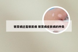 银霄病还是银屑病 银霄病皮肤病的种类