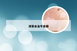 浓茶水治牛皮癣