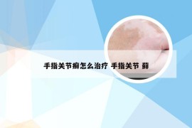 手指关节癣怎么治疗 手指关节 藓