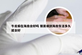 牛皮癣在海南会好吗 银屑病到海南生活多久就会好