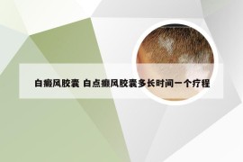 白癜风胶囊 白点癫风胶囊多长时间一个疗程