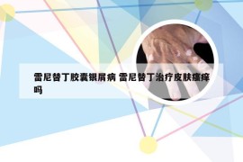 雷尼替丁胶囊银屑病 雷尼替丁治疗皮肤瘙痒吗