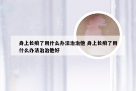 身上长癣了用什么办法治治他 身上长癣了用什么办法治治他好