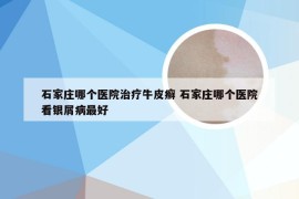 石家庄哪个医院治疗牛皮癣 石家庄哪个医院看银屑病最好