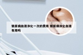 银屑病血液净化一次的费用 银屑病净化血液有用吗