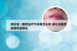 湖北省一医院治疗牛皮癣怎么样 湖北省医院皮肤科室排名