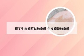 得了牛皮癣可以纹身吗 牛皮廨能纹身吗