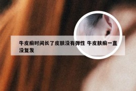 牛皮癣时间长了皮肤没有弹性 牛皮肤癣一直没复发