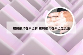 银屑病只在头上有 银屑病长在头上怎么治