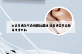 治银屑病关节炎哪医院最好 银屑病关节炎挂号挂什么科
