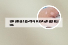 银屑病鳞屑自己掉落吗 银屑病的鳞屑需要刮掉吗