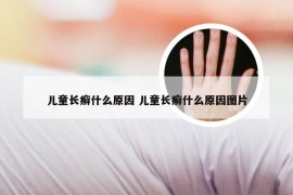 儿童长癣什么原因 儿童长癣什么原因图片