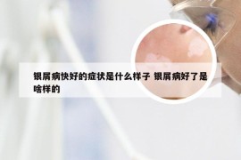 银屑病快好的症状是什么样子 银屑病好了是啥样的