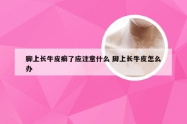 脚上长牛皮癣了应注意什么 脚上长牛皮怎么办