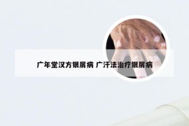 广年堂汉方银屑病 广汗法治疗银屑病