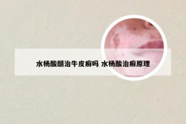 水杨酸醑治牛皮癣吗 水杨酸治癣原理