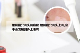 银屑病只有头屑症状 银屑病只有头上有,会不会发展到身上也有
