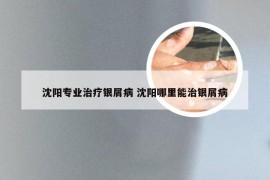 沈阳专业治疗银屑病 沈阳哪里能治银屑病