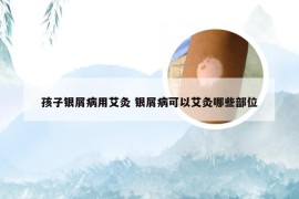 孩子银屑病用艾灸 银屑病可以艾灸哪些部位