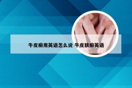 牛皮癣用英语怎么说 牛皮肤癣英语