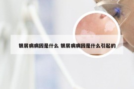 银屑病病因是什么 银屑病病因是什么引起的