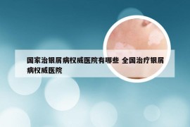 国家治银屑病权威医院有哪些 全国治疗银屑病权威医院