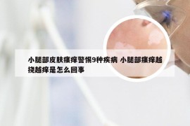 小腿部皮肤瘙痒警惕9种疾病 小腿部瘙痒越挠越痒是怎么回事