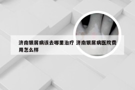 济南银屑病该去哪里治疗 济南银屑病医院费用怎么样