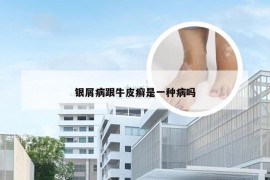 银屑病跟牛皮癣是一种病吗