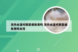 洗热水澡对银屑病有用吗 洗热水澡对银屑病有用吗女性