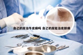 自己的尿治牛皮癣吗 自己的尿能治皮肤病