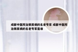 成都中医院治银屑病的名老专家 成都中医院治银屑病的名老专家是谁