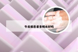牛皮癣患者多喝水好吗