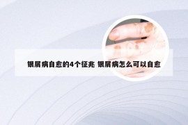 银屑病自愈的4个征兆 银屑病怎么可以自愈