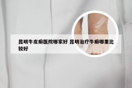 昆明牛皮癣医院哪家好 昆明治疗牛癣哪里比较好