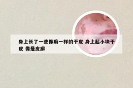 身上长了一些像癣一样的干皮 身上起小块干皮 像是皮癣