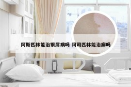 阿斯匹林能治银屑病吗 阿司匹林能治癣吗