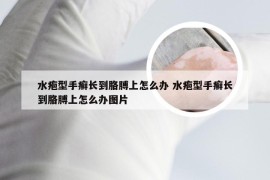 水疱型手癣长到胳膊上怎么办 水疱型手癣长到胳膊上怎么办图片