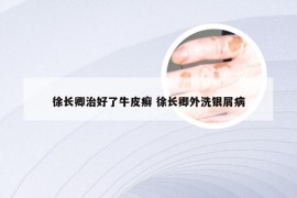 徐长卿治好了牛皮癣 徐长卿外洗银屑病