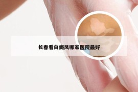 长春看白癜风哪家医院最好